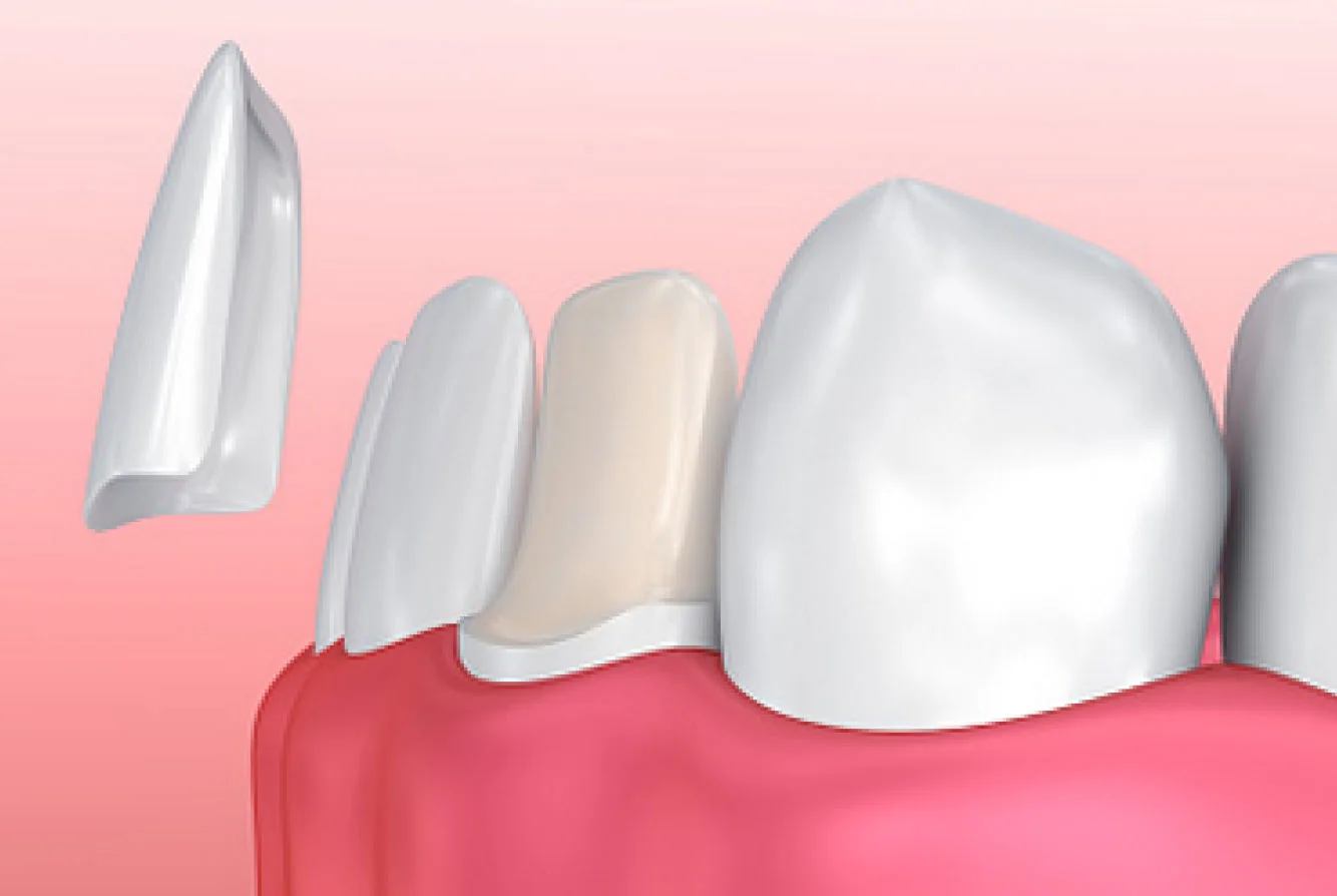 images_cosmetic-veneers.jpg
