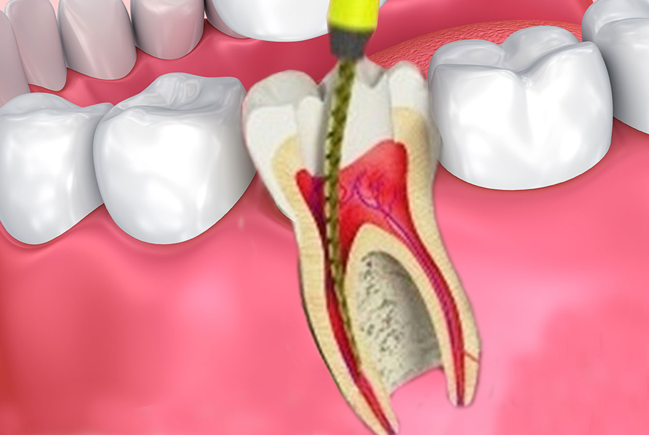 root-canal.jpg