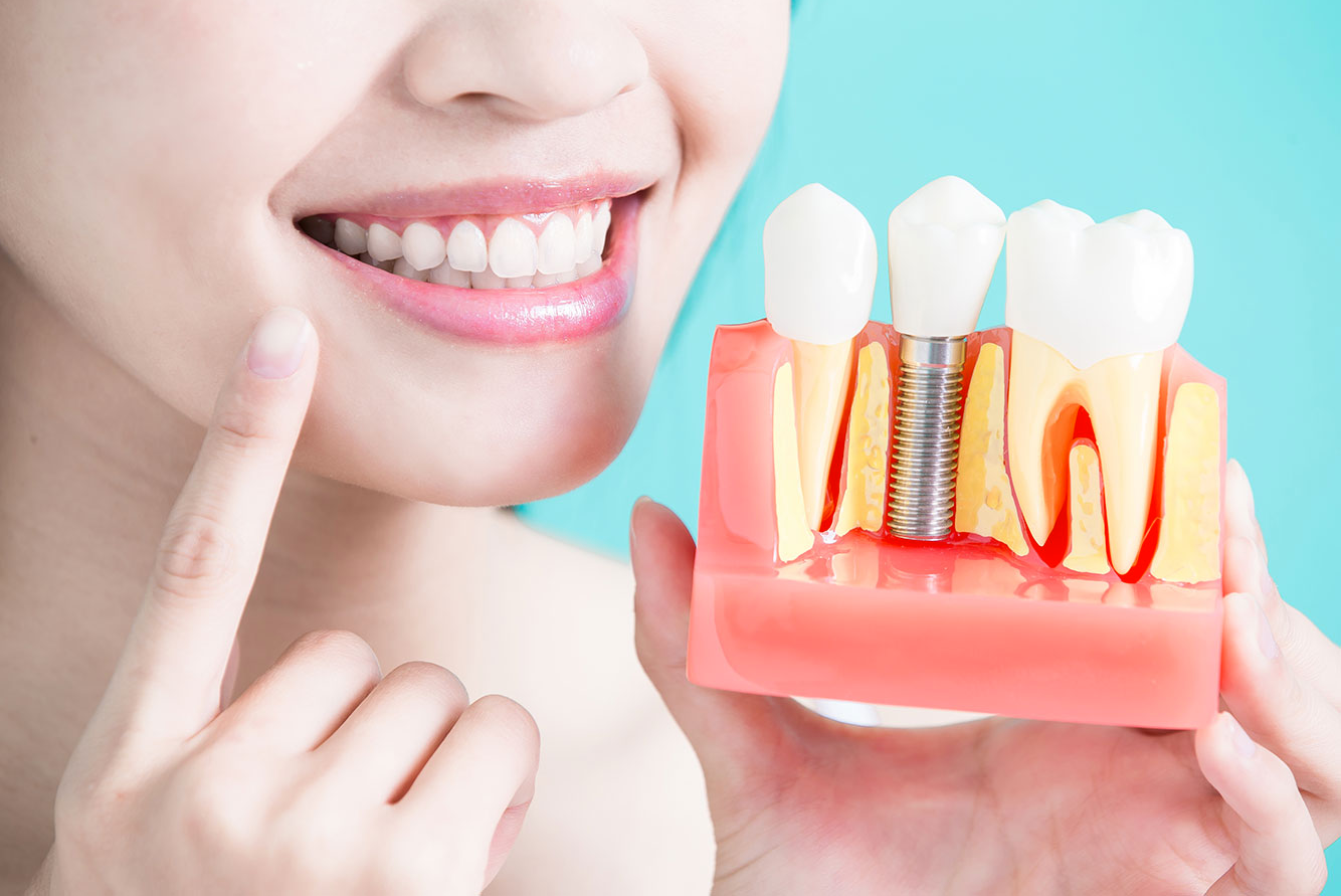 implants smile.jpg