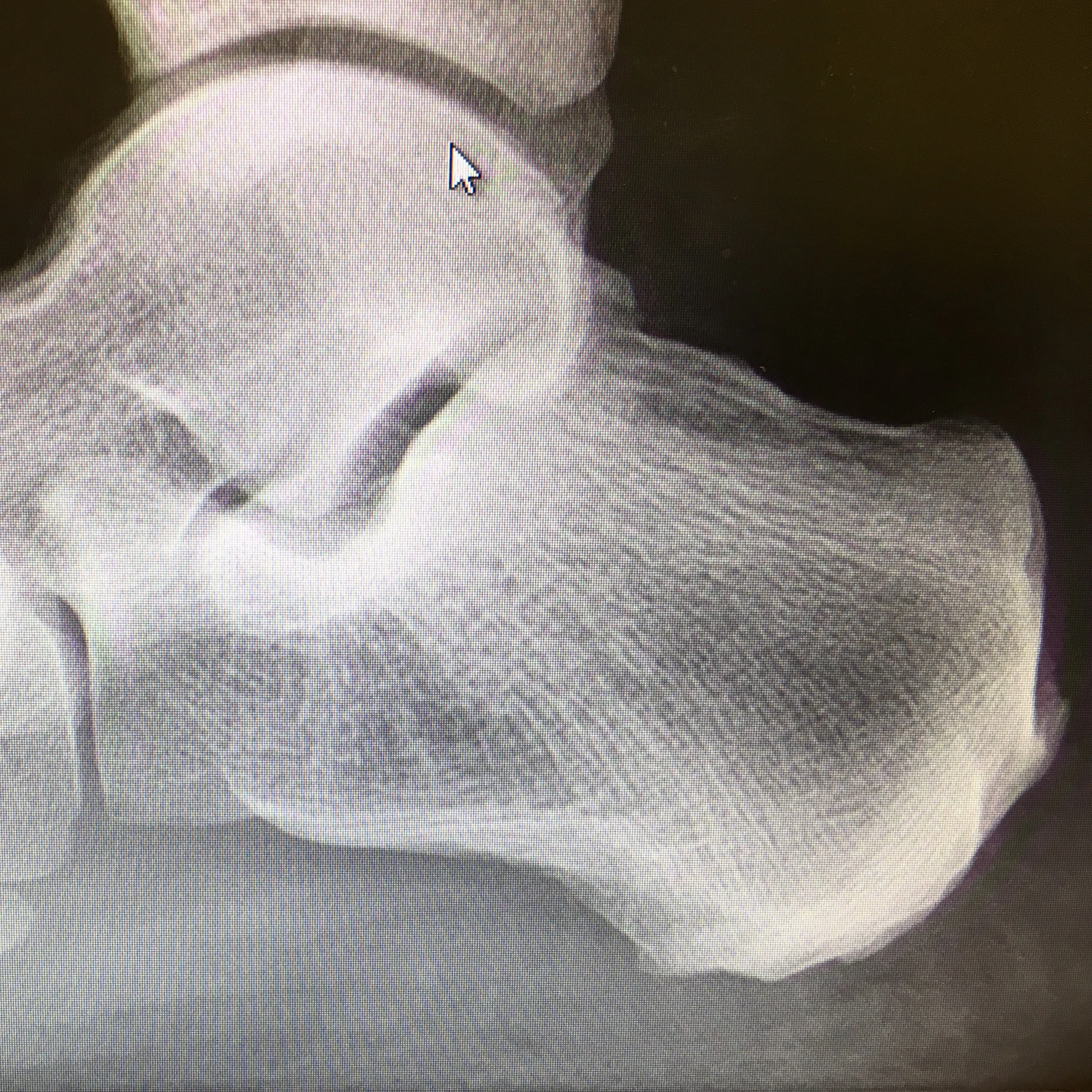 My heel
