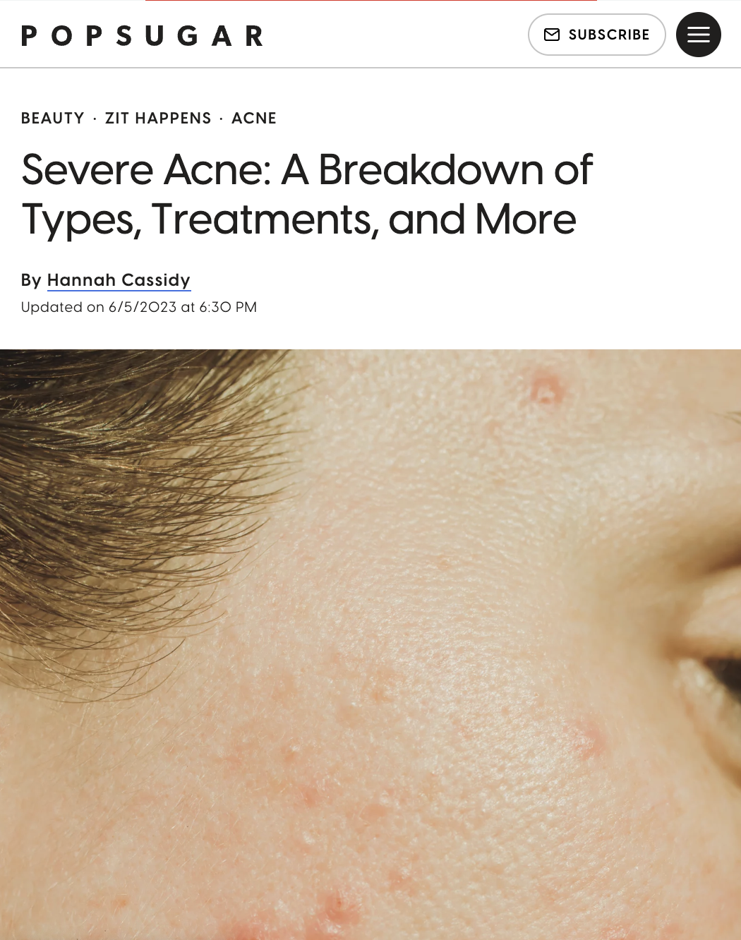 Severe Acne 101