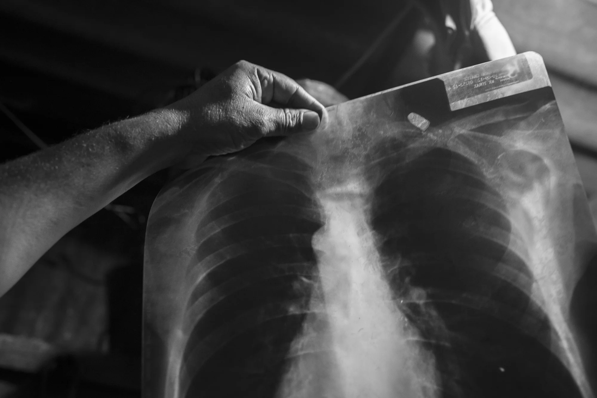 In 2009, Edwin was shot three times. He still have the bullets, one of them just over the collarbone.