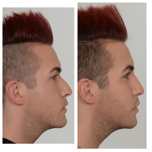 Here you can see the filler giving my nose more of a straight look.