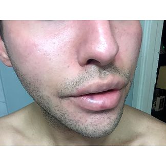 Wanted to give you a little insight to the bruising on the lips. This lasted about a week and it was very easy to cover up. Take a look!