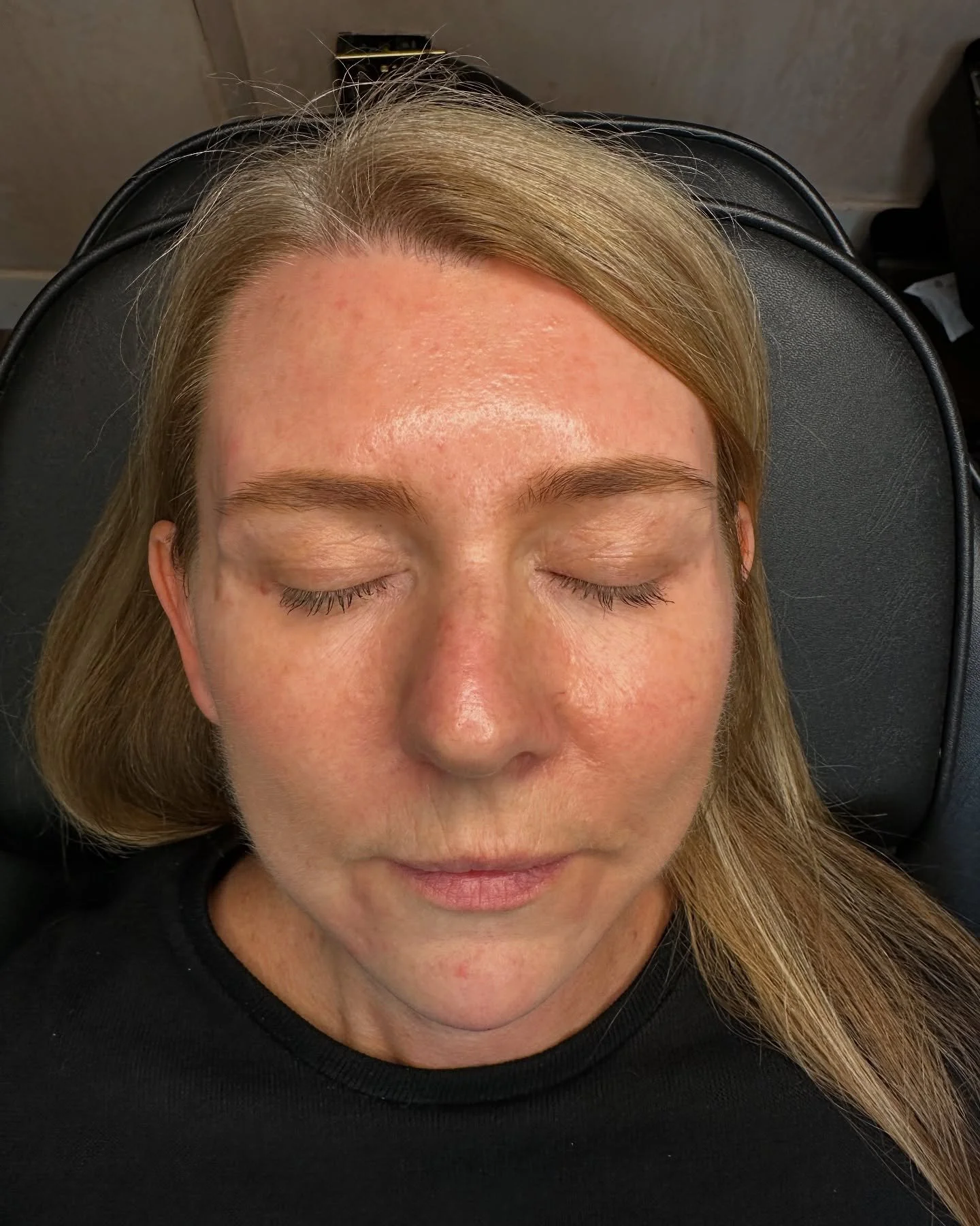 I am sooooo blessed to have people put their trust in me and allow me to join them on their aesthetic journey. I first met Nicola a year ago and we began using Btox in her full face to reduce signs of aging and wrinkles and support her lower face. Fa