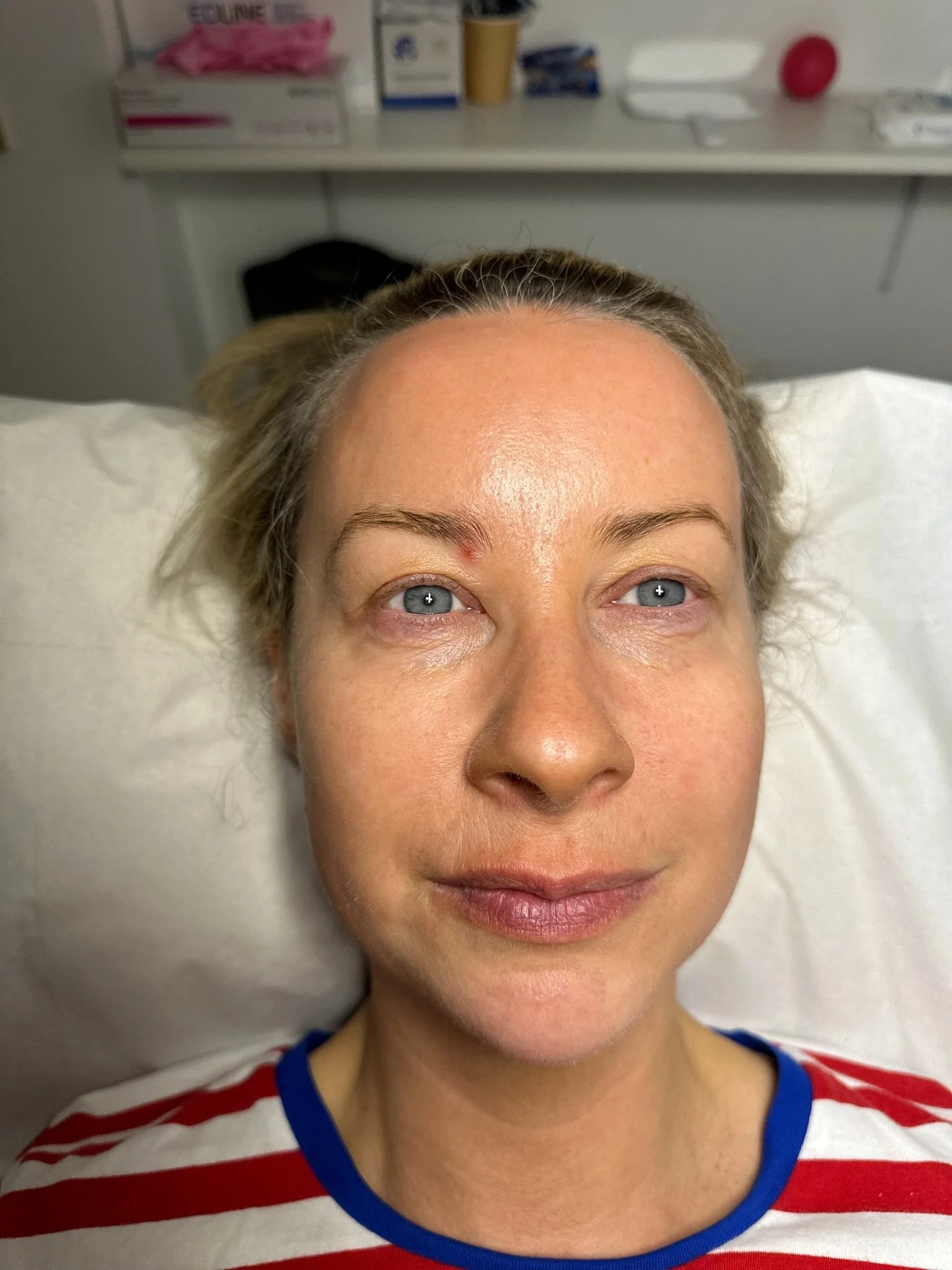 Swipe for the before 👉🏽 

Aesthetics and skincare are a journey&mdash;not a one-time fix. It&rsquo;s all about consistency and maintenance. 

💉 Anti-wrinkle: every 3&ndash;4 months (let it wear off or you risk resistance 😱)
💋 Filler: every 18&nd