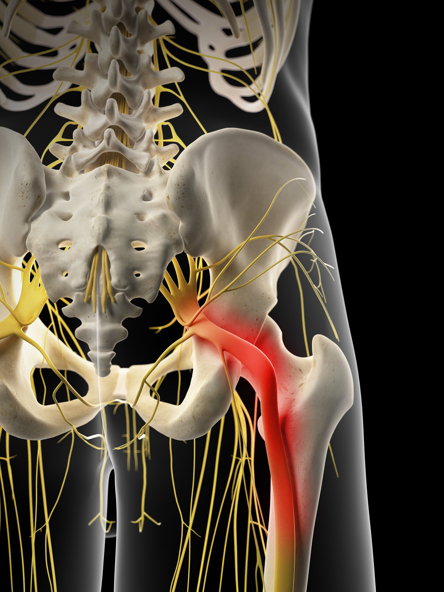 What is Sciatica and the Cause of Sciatic Nerve Pain?