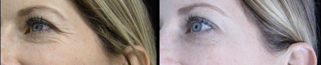 Before and After Botox® to Crows Feet
