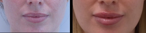 Lip Augmentation Before and After Filler