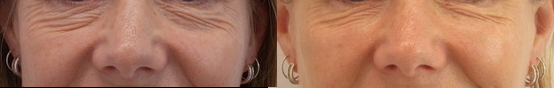 Mid Face Filler Before and After