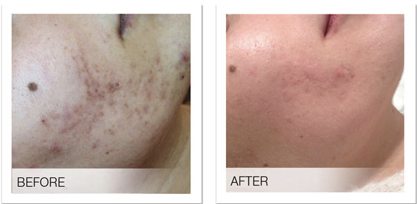 Sebaceous Gland Ablation Skin Body Health