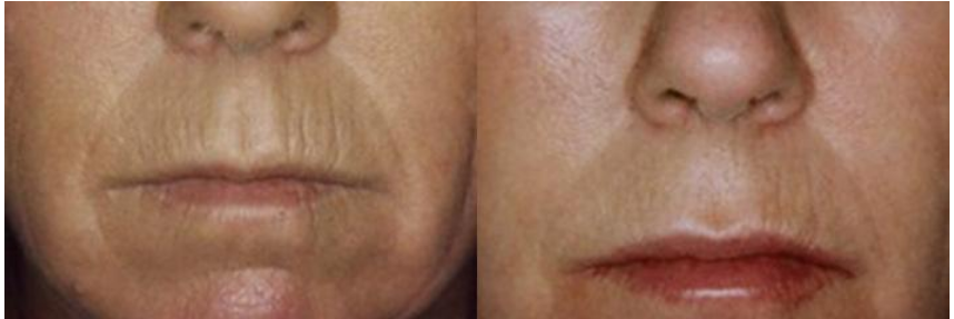 Collagen Induction Therapy pictures   Boston  MA   Patient 8911.png