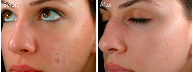 Skin Needling  What can it do    Permanent Makeup Designs   Cosmetic Tattoos   Madison  WI.png