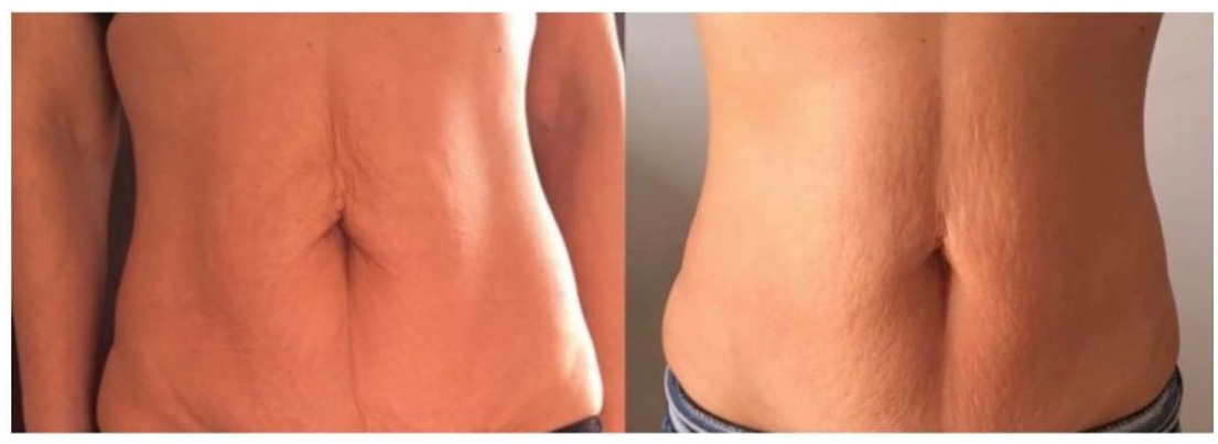 Renova Tummy B&A).jpg