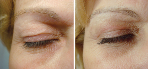 fibroblast plasma skin tightening what to expect.jpg