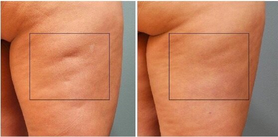 Bef after wrap cellulite.jpg