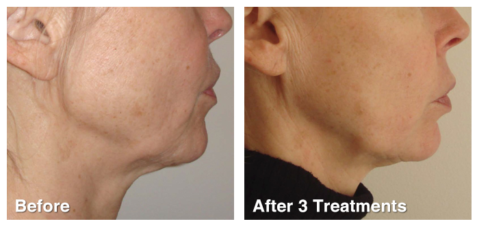 Before after 3 neckGeneo_3_in_1_Super_Facial_Technology_The_Global_Beauty_Group.png