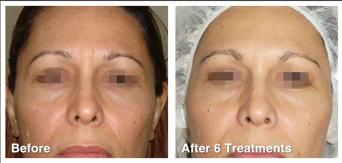 Before after 6 Geneo_3_in_1_Super_Facial_Technology_The_Global_Beauty_Group.png
