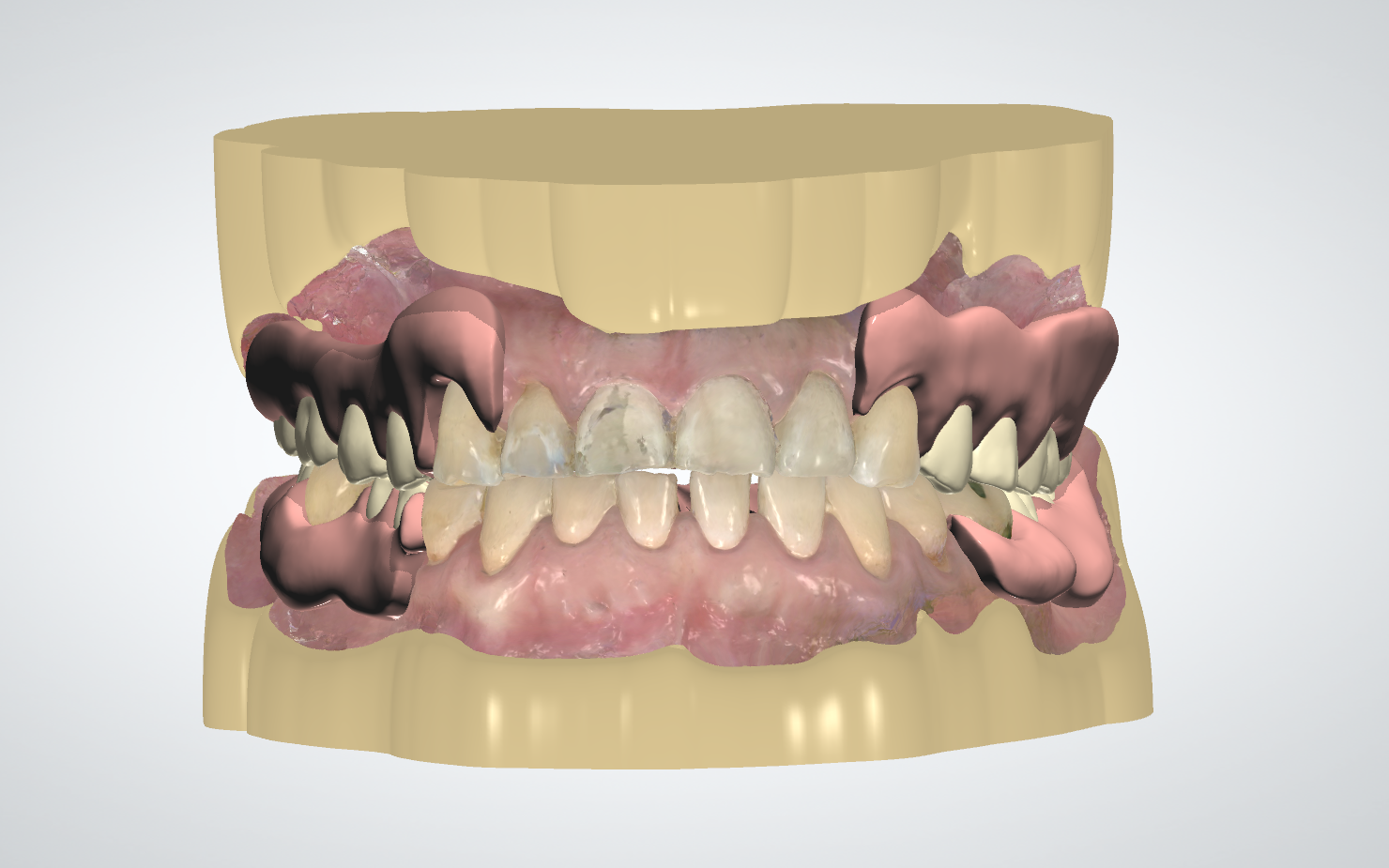 Valplast partial denture, designed with 3Shape Dental System from a TRIOS digital impression.