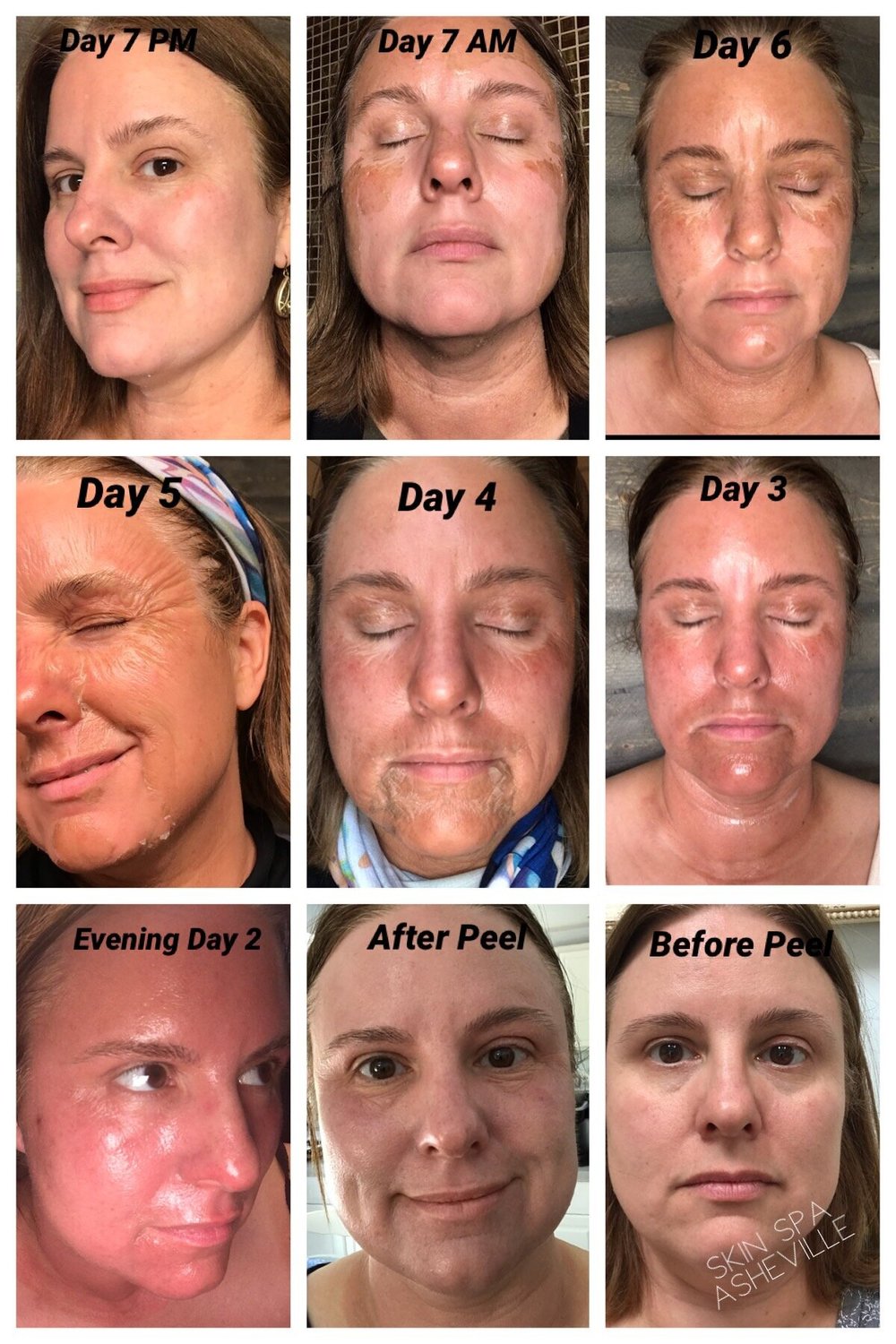 Elaine Brennan Peel, Micro Peel & Chemical Peels Skin Spa Asheville