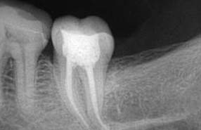 Root Canals