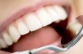 Veneers