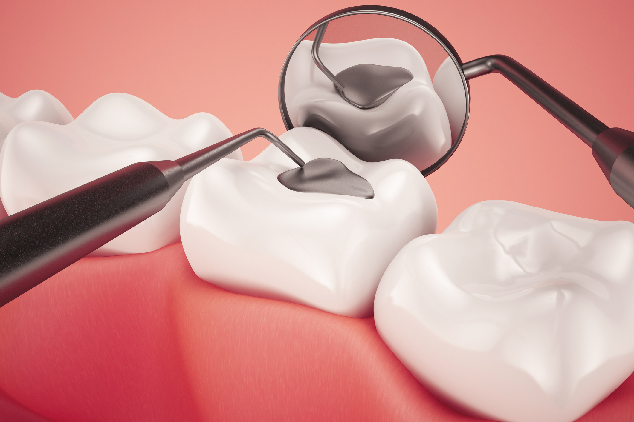 Fillings