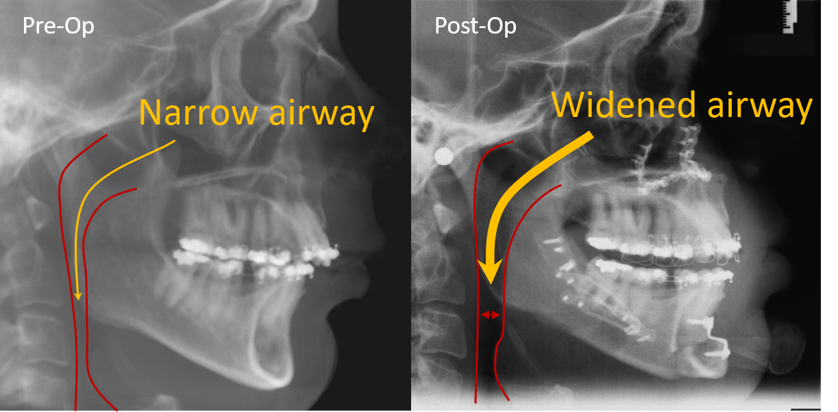 Obstructive Sleep Apnea Red Hills Oral Facial Surgery obstructive-sleep-apnea-red-hills-oral-facial-surgery