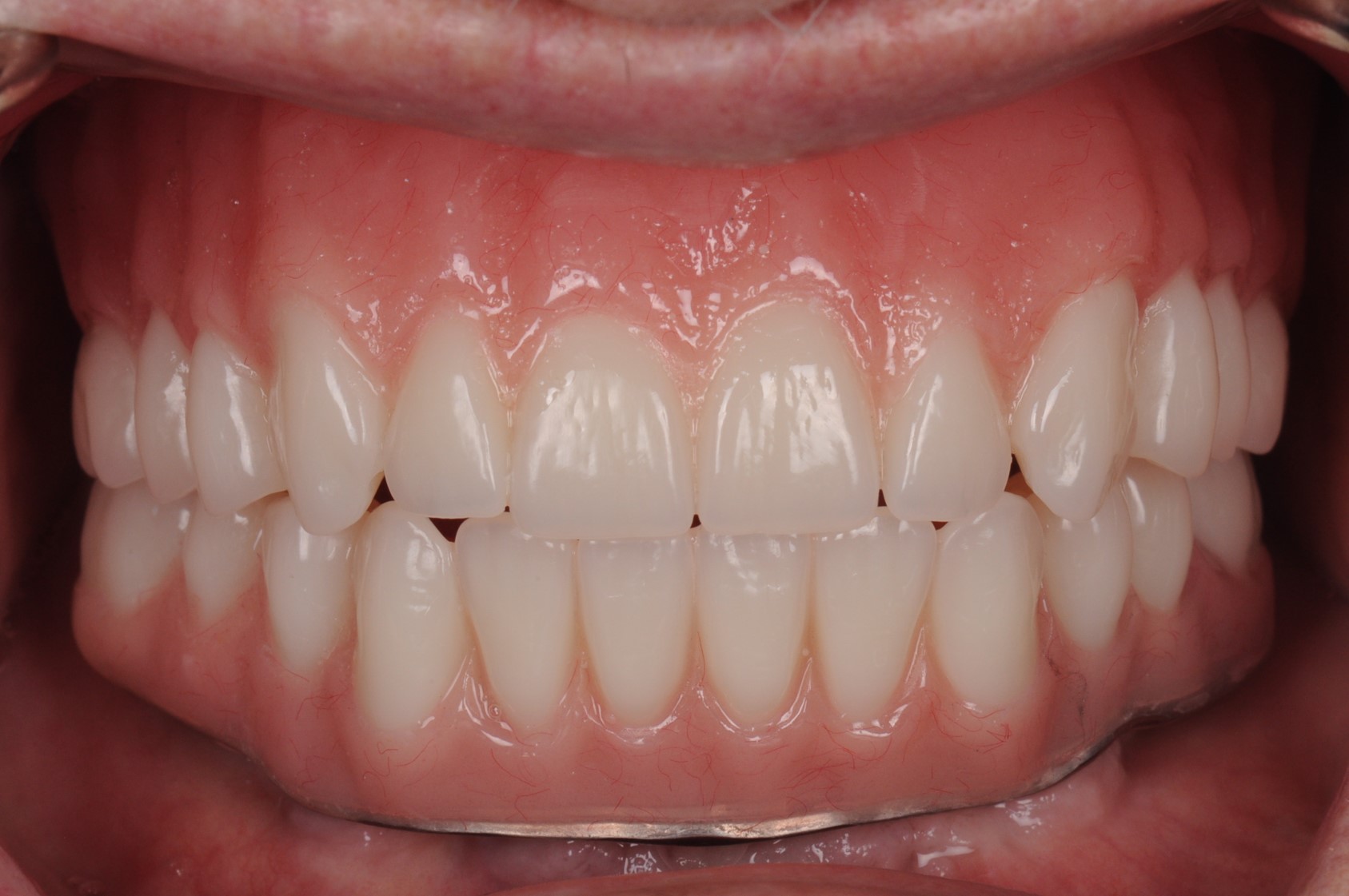 Case 3 - Final Teeth