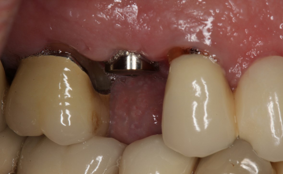 Case 1 - After Implant Placement
