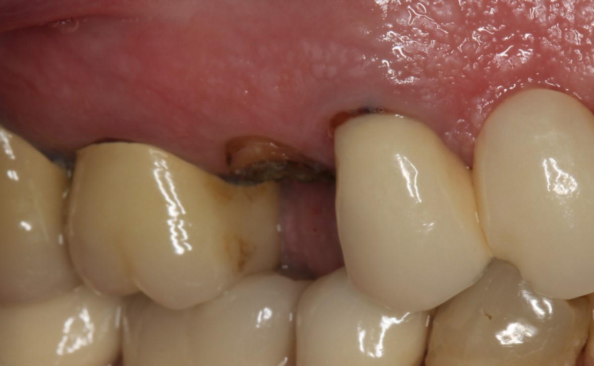 Case 1 - Broken Tooth