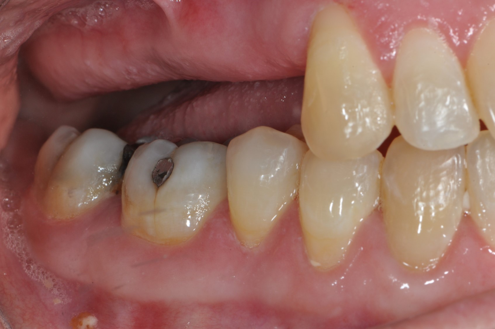 Case 2 - Multiple Missing Teeth