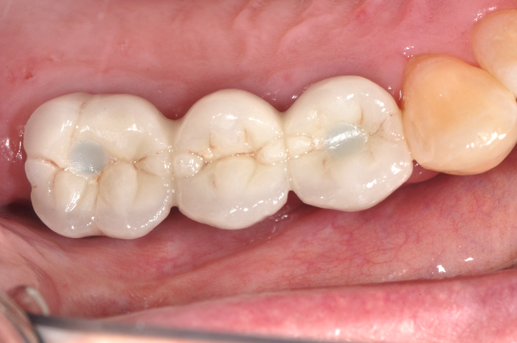 Case 2 - Top View of Implant Crowns