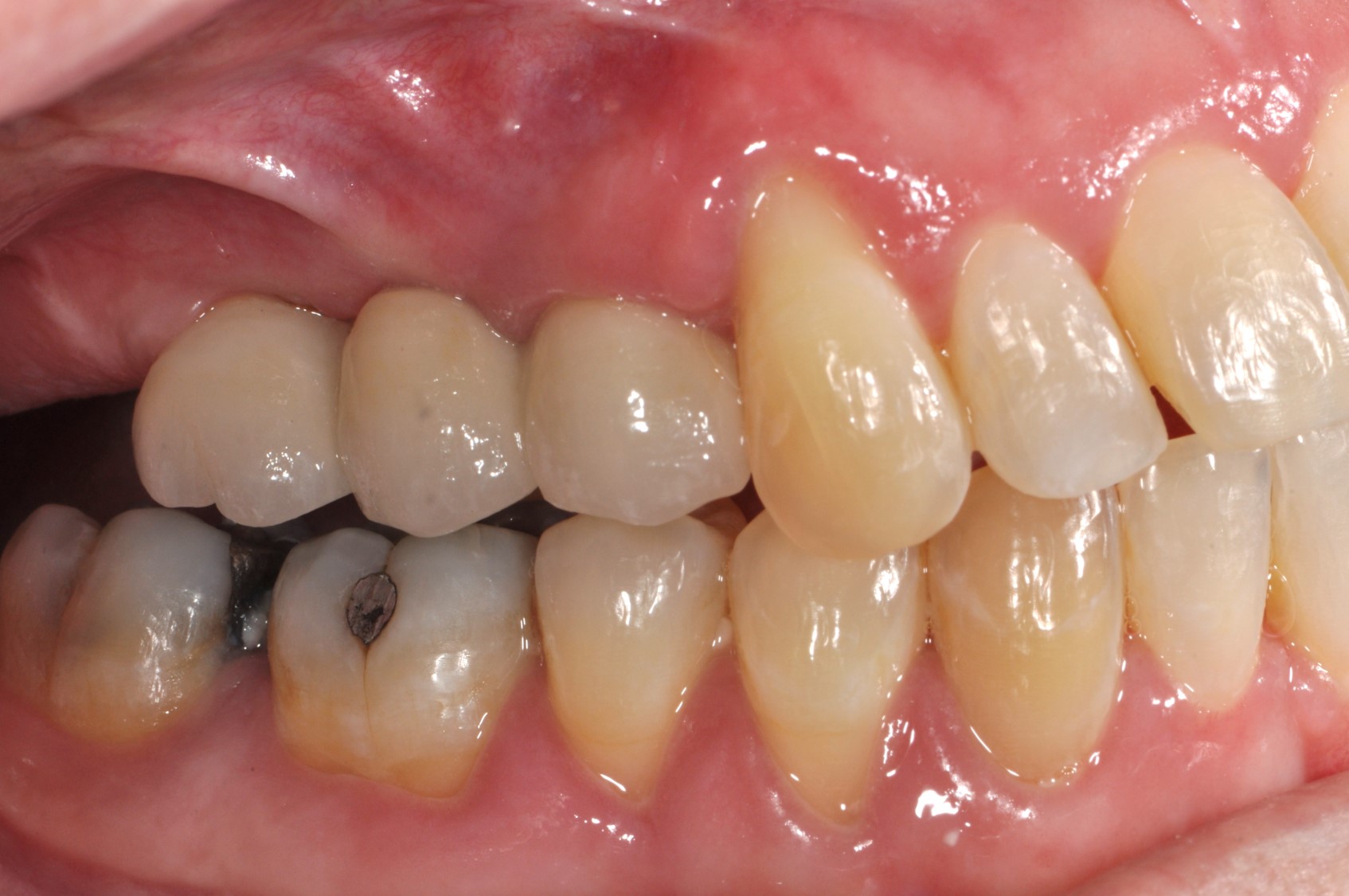 Case 2 - Multiple Crowns Attached to Implants