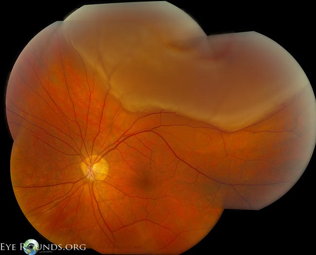 Rhegmatogenous-retinal-detachment.jpg