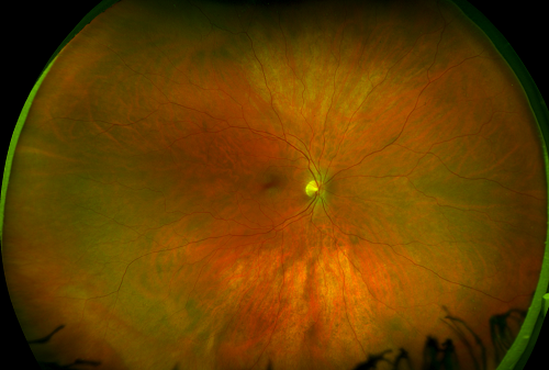 Renton Vision Clinic Healthy Retina Optomap.png