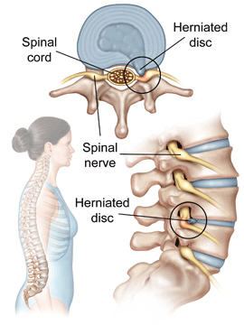 Herniated disc.jpg