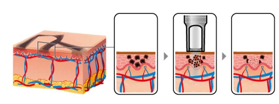 The tattoo ink is broken into tiny particles by the laser, and then the ink is digested naturally by the body.