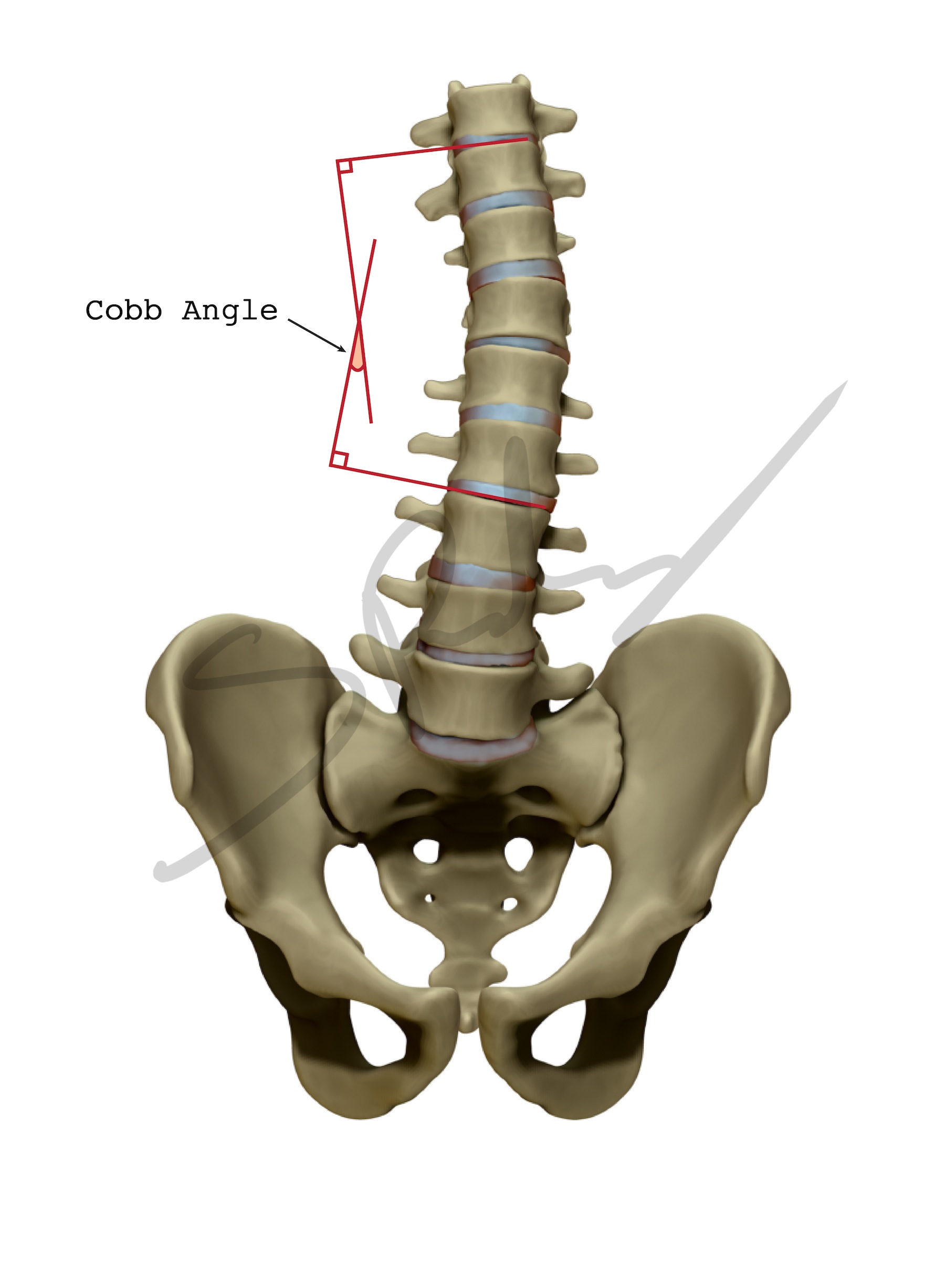 CobbAngleWeb.jpg