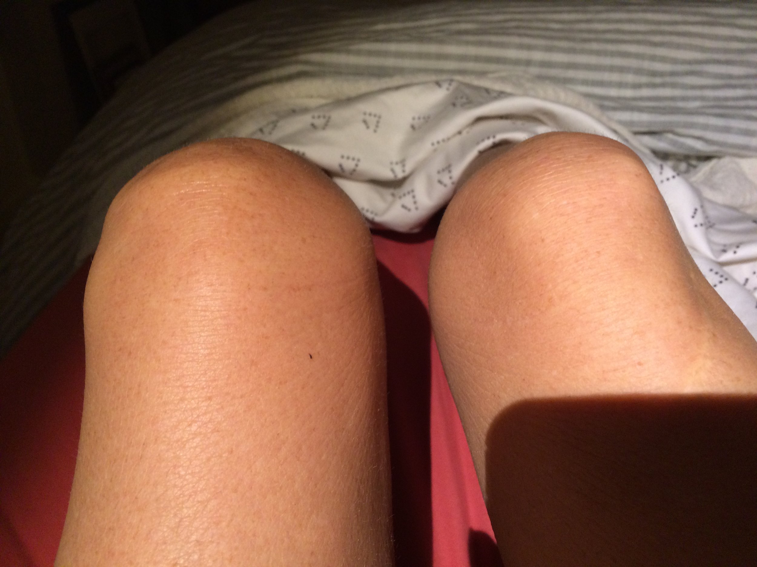 Pretty sure it's a torn meniscus. Yuck.