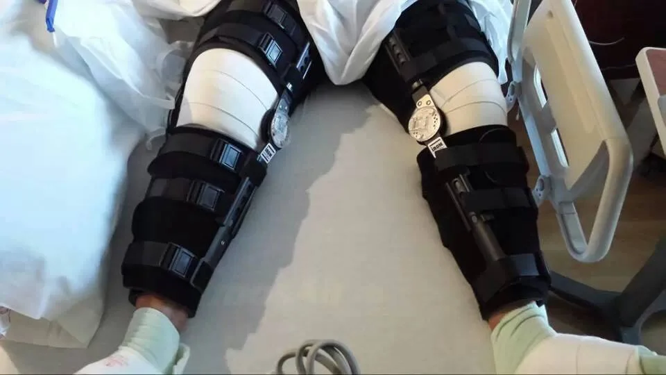 My legs after surgery to reattach my ruptured quadriceps tendons, july 27, 2013.