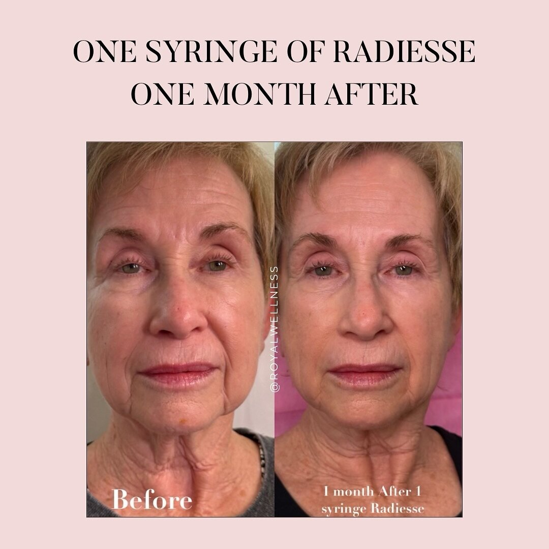 Facial rejuvenation with Radiesse ✨

It&rsquo;s time for a more sculpted face using Radiesse. It&rsquo;s one of the most defining, contouring fillers that also stimulates collagen &amp; elastin. 

It&rsquo;s a great injectable for anchoring your jaw 