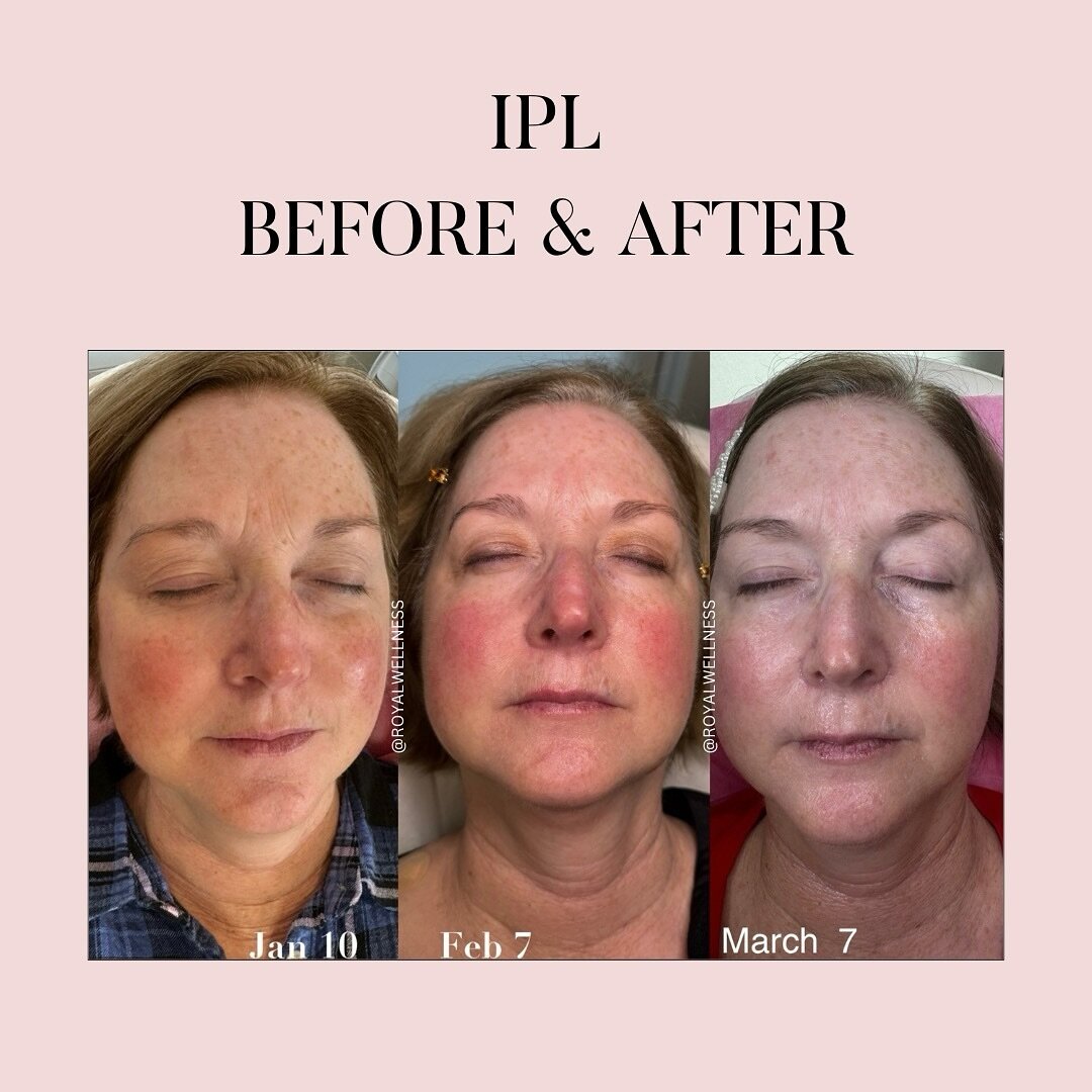 One IPL is a treat, 3 IPL&rsquo;s = TreatMENT 

IPL = eraser of red and brown spots 

What are the benefits? ⬇️
- improves tone and texture 
- reduces appearance of sun damage 
- reduces fine lines and wrinkles 
- reduces hyperpigmentation, age spots