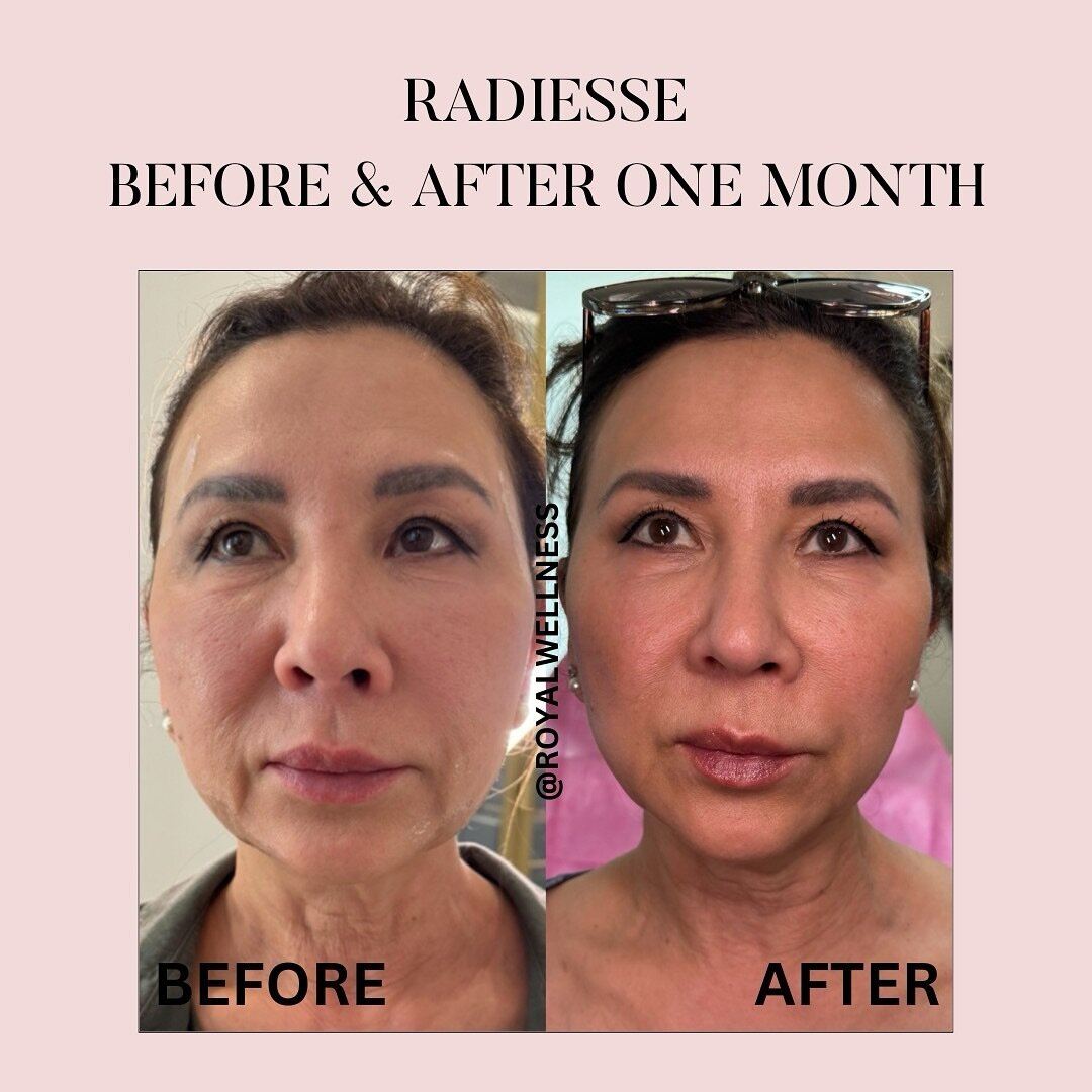 Are you ready to experience smoother, younger-looking skin with Radiesse? 

Hyperdilute Radiesse stimulates the production of collagen and elastin - two proteins that control the skin&rsquo;s hydration, resilience, and glow. It can help to tighten, f