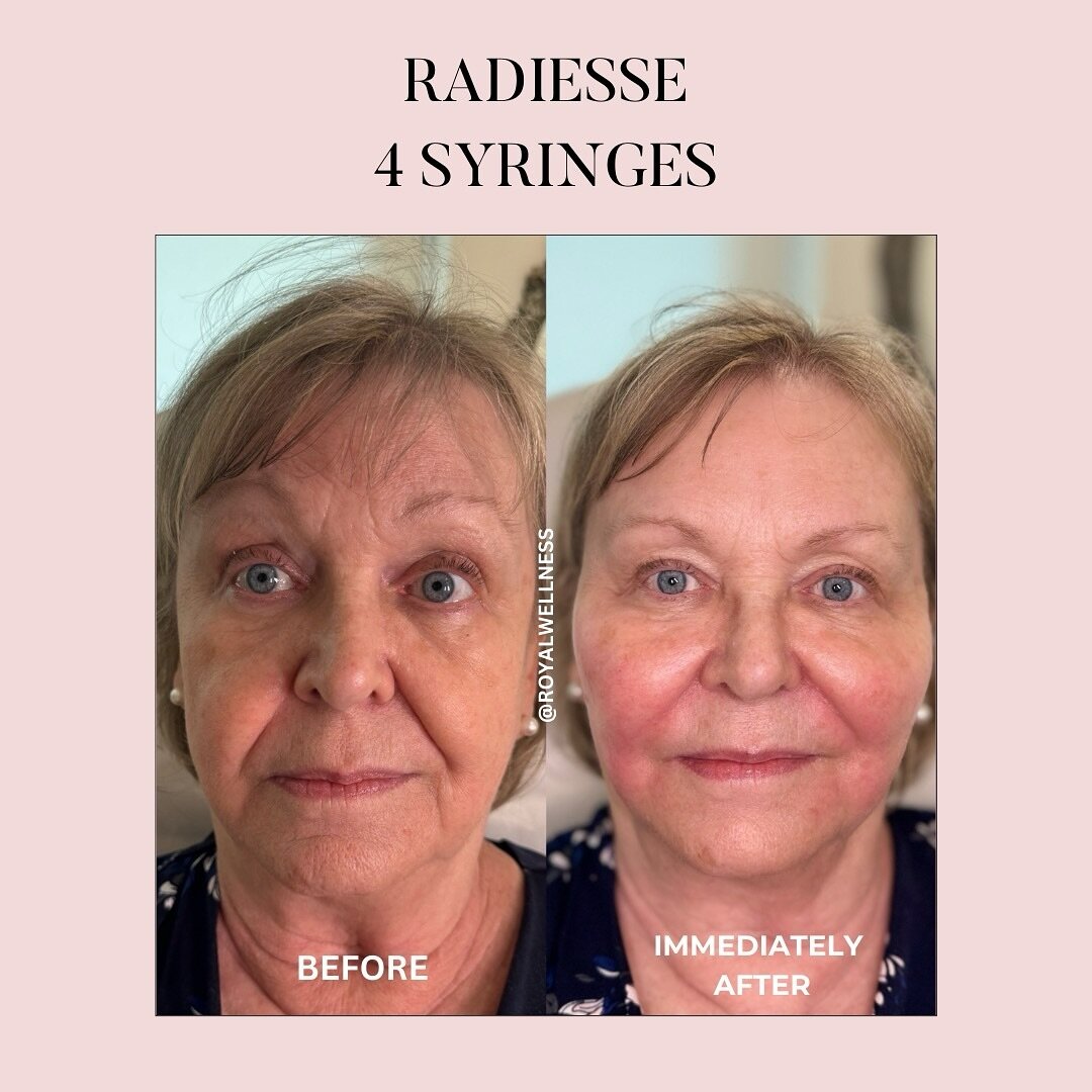 Immediately after 4 syringes of Radiesse (A filler &amp; biostimulator) 

We will update you with her results after one month - we love that Radiesse continues to work to stimulate your own collagen + elastin ✨

More benefits: 
🤍Facial symmetry 
🤍L