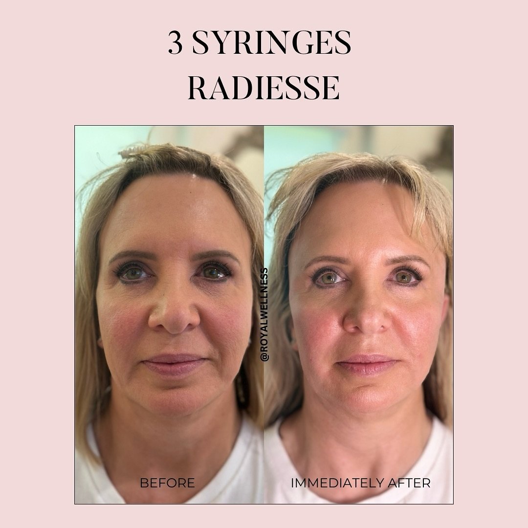 Facial Fertilizing with Radiesse 🌸

When we use biostimulating fillers, it causes
collagen and elastin type 1 and III to grow back
in the skin. Biostimulating filler trigger your skin&rsquo;s natural production of collagen and elastin, the building 