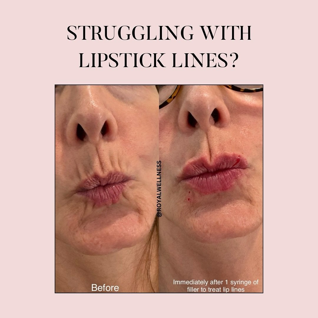 Bye lip lines 👋🏻 

Ready to minimize those lines &amp; wrinkles? Book your appt through the link in bio! 

#filler #fillerbeforeandafter #lipsticklines #finelinesandwrinkles #medspa #aesthetics #antiagingskincare #antiagingtreatment #injectablefill