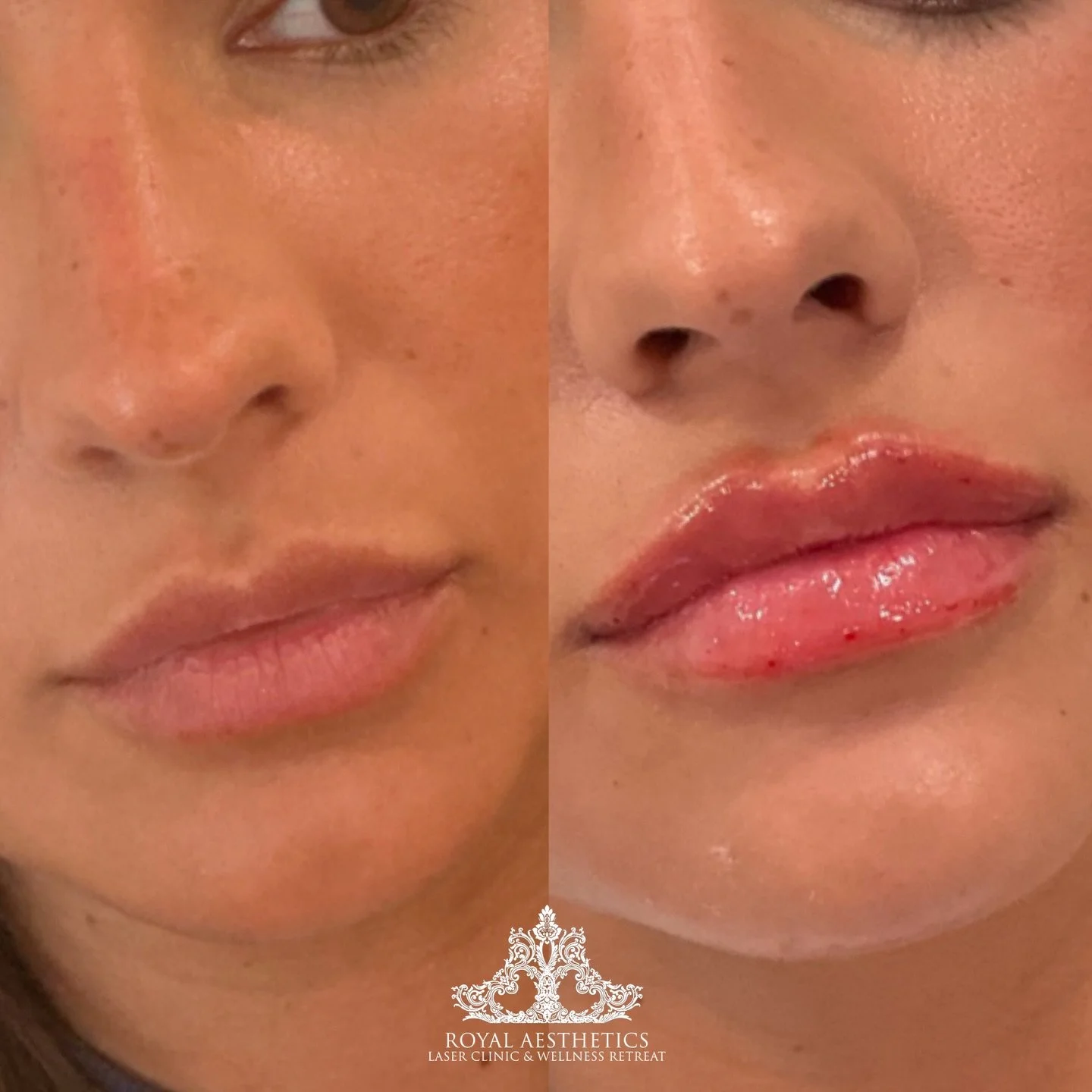 I love a &frac12; syringe moment💋
Just enough to enhance, never enough to overpower. 

If you&rsquo;ve been wanting a soft, balanced, effortless enhancement, I&rsquo;d love to work with you. Book now through the link in my bio! 

#texasinjector #lip