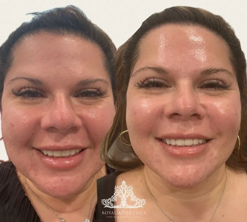 Before &rarr; Afters that speak for themselves✨

Subtle, strategic, and still her&hellip; just refreshed.

Using Radiesse, we focused on restoring volume and softening areas of shadow to bring light back to the face without changing her natural featu