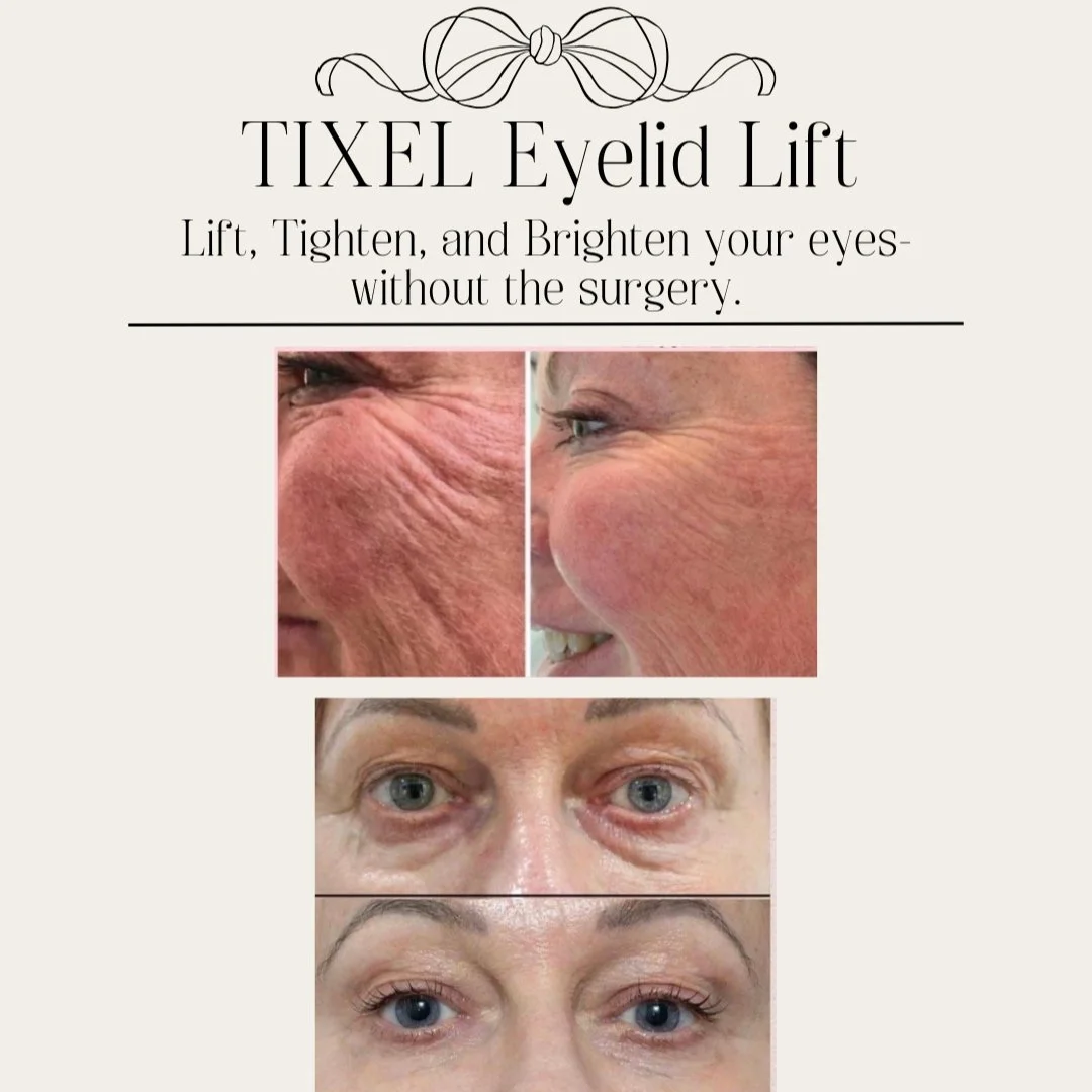 TIXEL EYELID LIFT